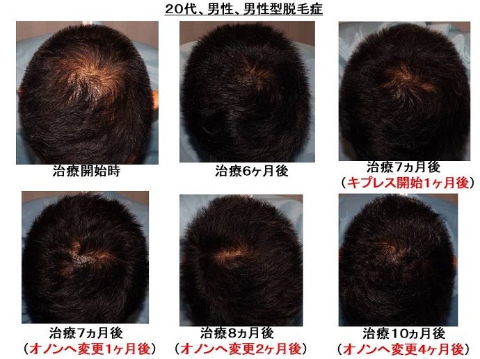 円形脱毛症　病院""